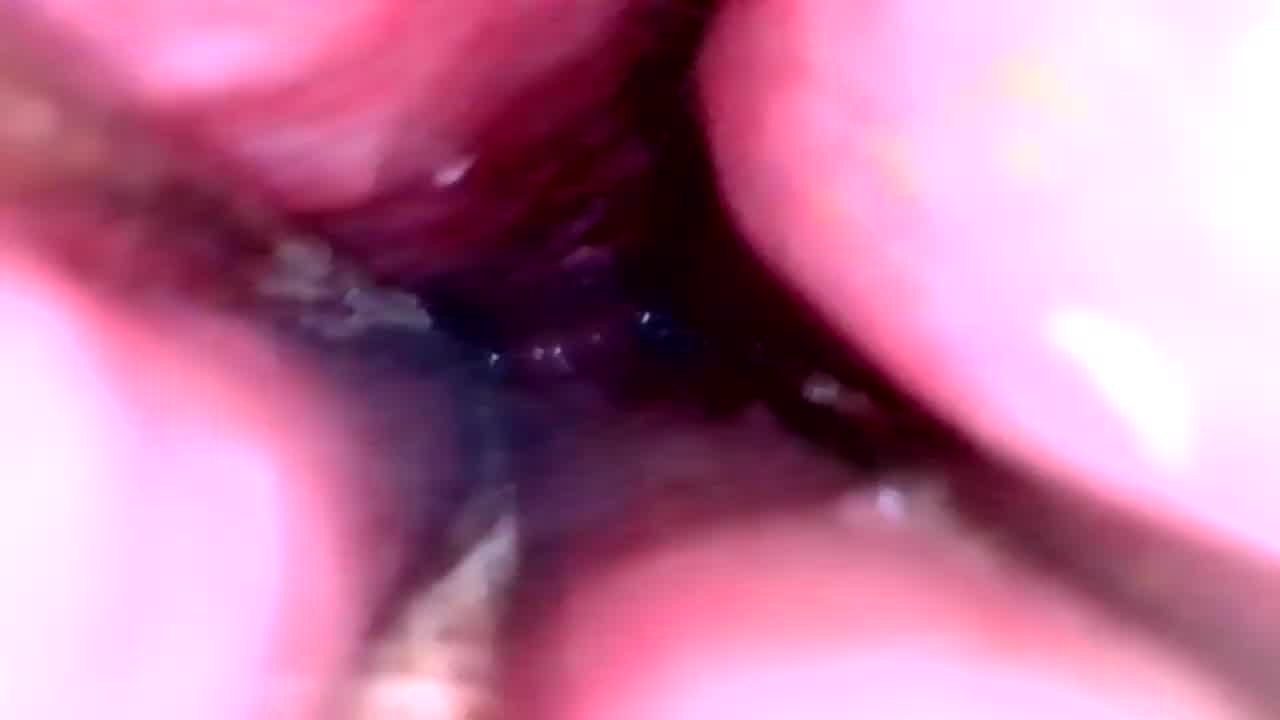 Deep Insight Into Wide Open Urethra Part 2 After Hot Wax Hotntubes