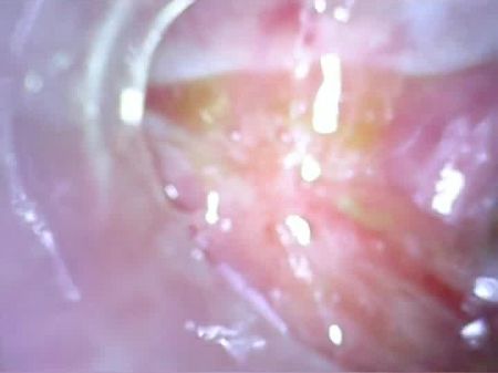 Deep Rectal Again Home Colonoscopy Endoscope Part 1