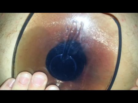 Extremo Estiramiento Anal De La Analización Anal 