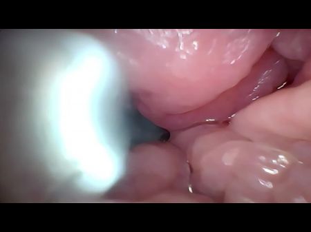 Mancum In Cervix Wide Spreading Puss Endoscope !